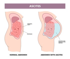 dialysate cleansing home care tube fluid drain bag waste High blood cysts center manual port End Stage renal ESRD Infusion Diffusion fatty liver tap cancer B C Use pain cavity portal peritoneocentesis