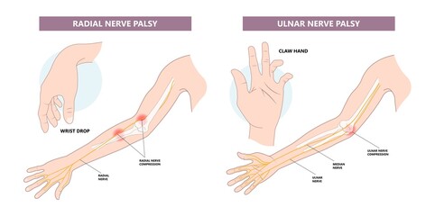 Pronator teres syndrome of nerve palsy carpal tunnel claw hand sport injury pain arm elbow joint ulnar wrist drop distal outlet neuropathies fall Radial motor tendon night Phalen test preacher papal - obrazy, fototapety, plakaty