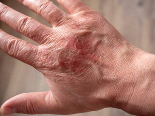 Scars on the skin of the hand after a burn. Healing burns on the arm.
