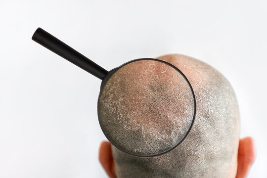 Man's bald flaky head with dandruff and zoomed with magnifier problem area, back view. White background. The concept of psoriasis, sunburn and seborrheic dermatitis