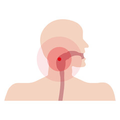 Schematic representation of throat diseases, sore throat