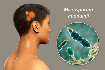 Fungal infection on a man's head, 3D illustration