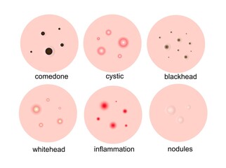 Pimples on the skin. Types of acne, acne comedones, cystic, inflammation, whiteheads on the face.Vector illustration.
