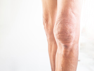 Leg and knee of an old man with synovial problems on a white background