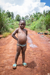 African child suffering from Kwashiorkor. His belly is swollen from malnutrition - obrazy, fototapety, plakaty