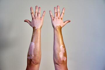Vitiligo skin disease on male hands