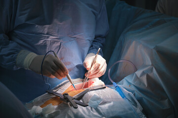 Closeup of doctors hands operating a patient conducting open cut surgery in surgical room. Healthcare and medical intervention concept
