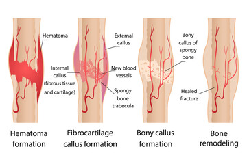 Stages of healing of bone fractures. - obrazy, fototapety, plakaty