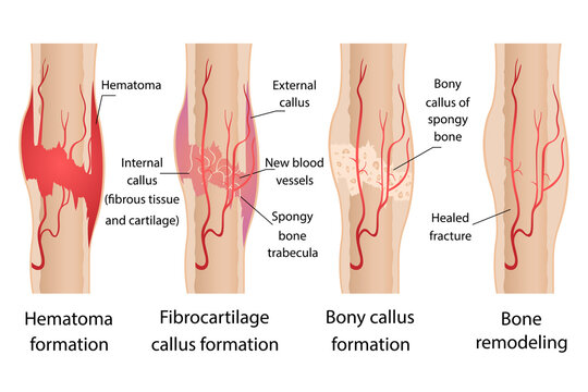 Stages of healing of bone fractures.