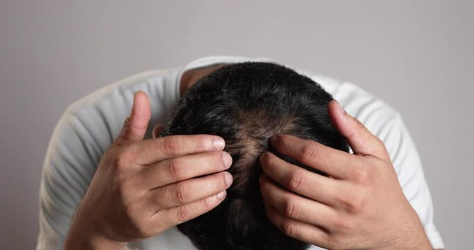 man examining his bald patches on scalp, male pattern hair loss