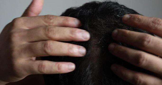 Male baldness, hair loss, dandruff on head, visible scalp. Man touching his thinning hair or alopecia head.