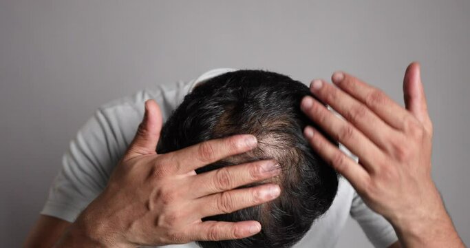 man showing visible hair loss scalp and examining bald patch