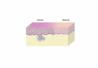 morphology of cervical cancer under a microscope, illustration, vector, eps