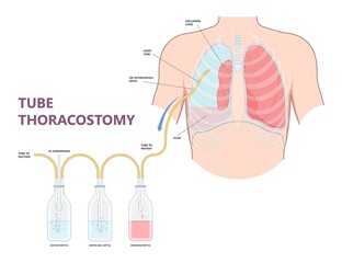 Lung cancer collapse chest pain drain rib bleb blunt insert tube fluid care disease cystic surgery oxygen blood triangle of safety suction pleurisy bleeding pus failure edema placement Disease Therapy