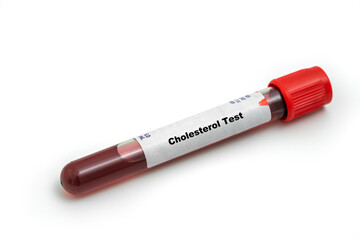 Cholesterol Test Medical check up test tube with biological sample