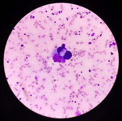 Microscopic view of blood smear, hematological stained slide, abnormal blood cell.