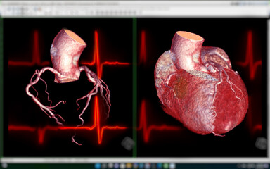 CTA Coronary artery  3D rendering image on the screen  for diagnosis of vessel coronary artery stenosis .