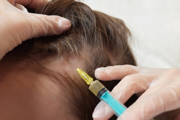 Plasma treatment, plasmolifting or PRP method point the introduction of the patient's own plasma...