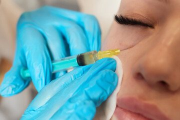Syringe with a patient's blood plasma in a cosmetologist's hand for a plasmolifting of a woman's...