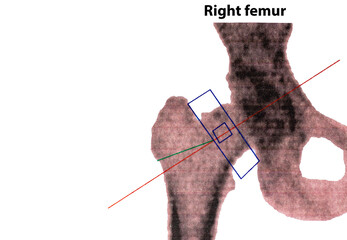 Close-up photo of the right femoral DEXA-osteodensimetry test, which measures bone density using X-rays, the imaging method used to diagnose osteoporosis; copy space - obrazy, fototapety, plakaty