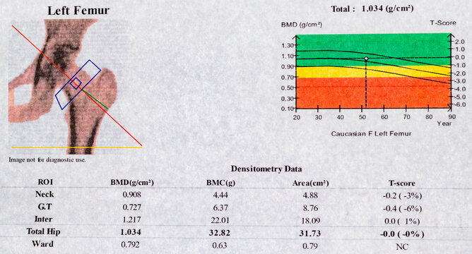 Close-up photo showing a graph, diagram, and curve of bone mineral density (BMD), a method used to investigate osteoporosis in women over 50
