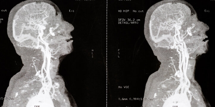 Close-up photo of a contrast-enhanced MRI of the skull and cerebral blood vessels of a person suspected of carotid stenosis; magnetic and nuclear resonance as a diagnostic method in neurology