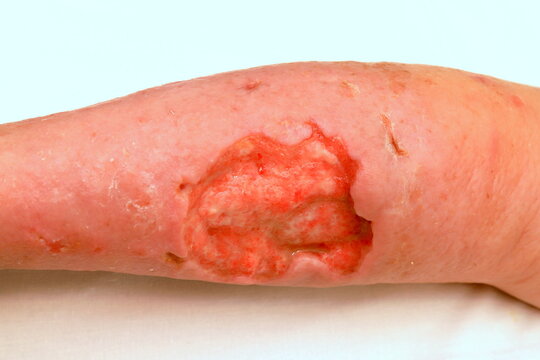 Deep trophic ulcer on leg, defect of skin and soft tissues. Complications of varicose veins of lower leg, weeping trophic wound, eczema, dermatitis. severe medical illness