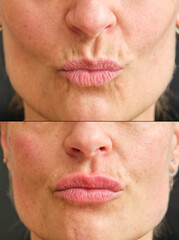 before and after lips with botulinum toxin