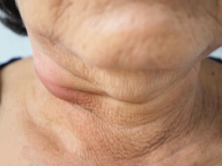 Woman neck lymph node inflammation. closeup photo, blurred.