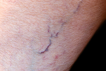 Fototapeta premium Prominent veins visible through the thin skin of Asian woman.