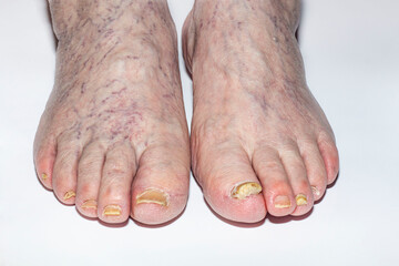 legs of an elderly woman with fungal nail damage and protruding veins