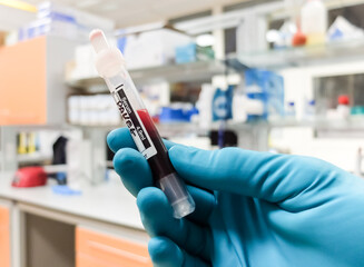 A blood samples collected into a special tube for disease diagnostics purpose.
