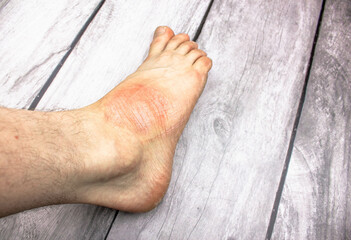 Foot health. Bare foot. Foot disease. Male foot.