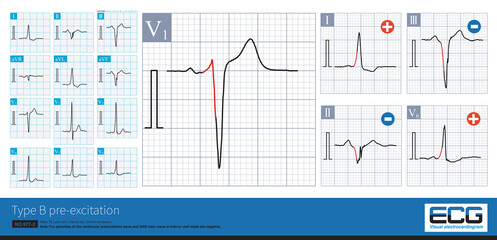 Male, 36 years old, without any clinical symptoms. Type B preexcitation was found in ECG, and the deduced accessory pathway was located in the right heart and posterior free wall.