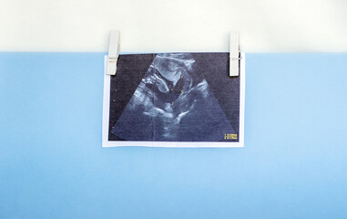 one ultrasonic picture with fetus and subchorionic hematoma or hemorrhage. bleeding under one of...