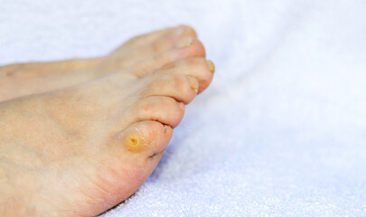 Callus on finger,close up. little toe of a woman's foot. elder woman legs on white, blue tones bath...
