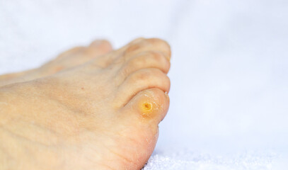 Callus on finger,close up. little toe of a woman's foot. elder woman legs on white, blue tones bath...