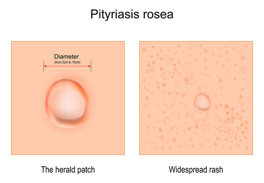 Pityriasis rosea. skin rash.