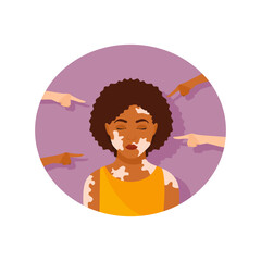 Portrait of an upset dark-skinned woman with vitiligo surrounded by pointing hands. Bullying and discrimination