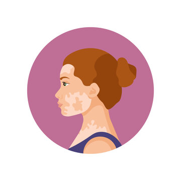 Vector picture of a young woman with vitiligo