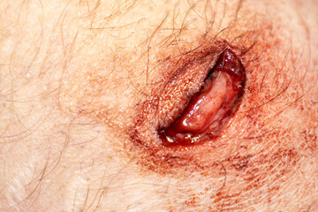 Open wound on knee. Blood comes from a wound on the leg, close-up, cut leg
