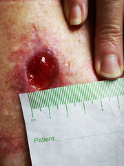 Wound Dehiscence measuring 2 cms - occurs when medical stitches, staples, or surgical glue have split apart, or if you see any holes forming in the wound. Packing of the wound is required until healed