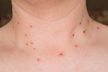 Red dots on the neck after removal of papillomas and warts.