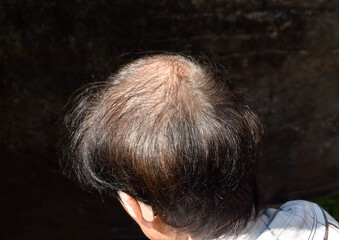Thinning or sparse hair, male pattern hair loss