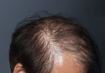 Thinning or sparse hair, male pattern hair loss
