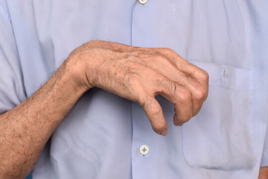 Volkmann&rsquo;s contracture in Southeast Asian elder man.