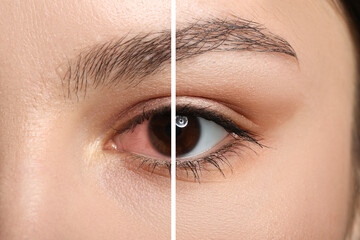 Closeup view of young woman before and after eye treatment