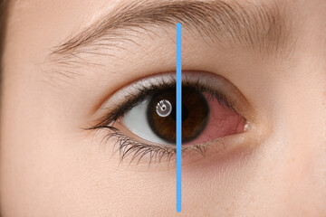 Closeup view of little girl before and after eye treatment