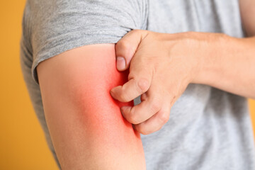 Young man scratching his skin, closeup. Allergy concept