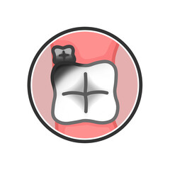 虫歯になった人間の奥歯